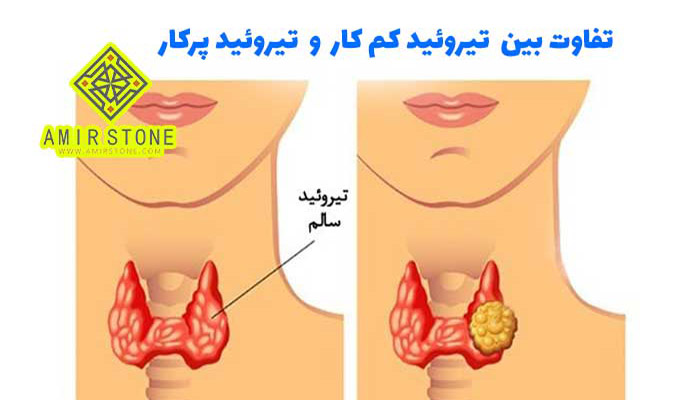 تفاوت تیروئید کم کار و پر کا